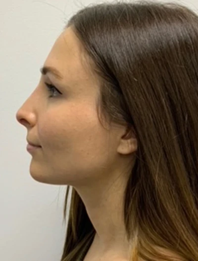 Rhinoplasty