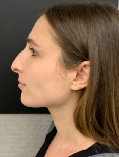 Rhinoplasty