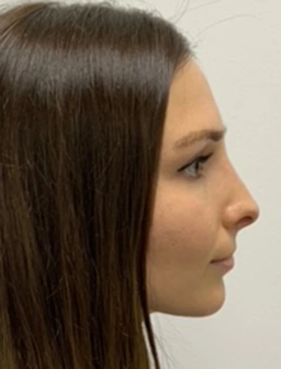 Rhinoplasty