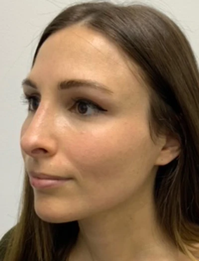 Rhinoplasty