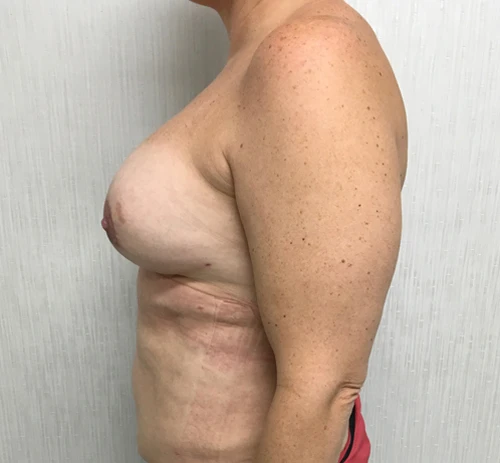 Breast Augmentation with Lift