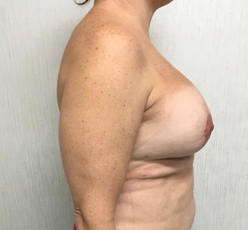 Breast Augmentation with Lift