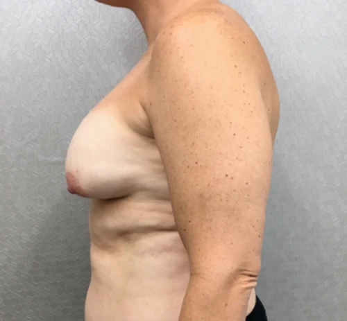 Breast Augmentation with Lift