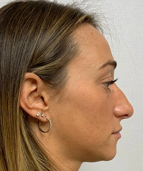 Rhinoplasty