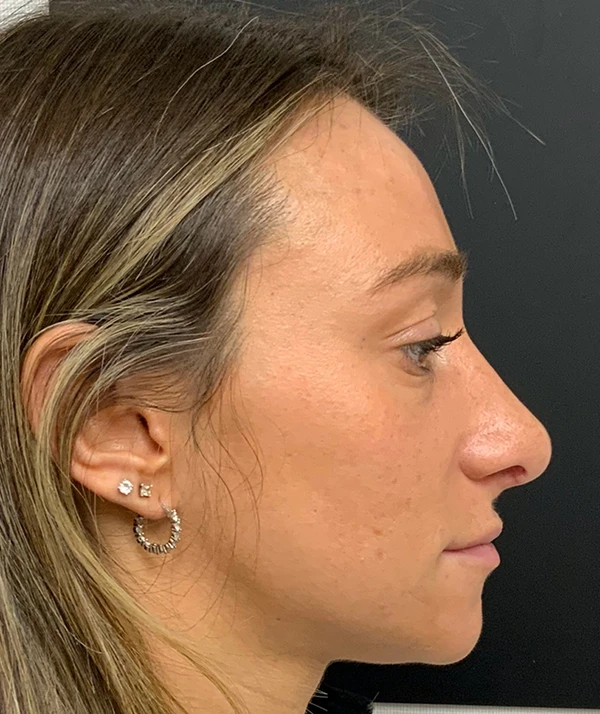 Rhinoplasty