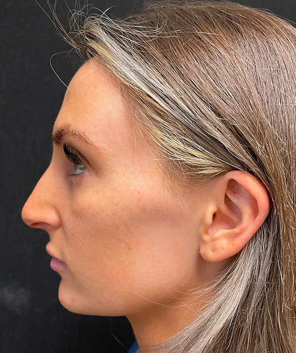 Rhinoplasty