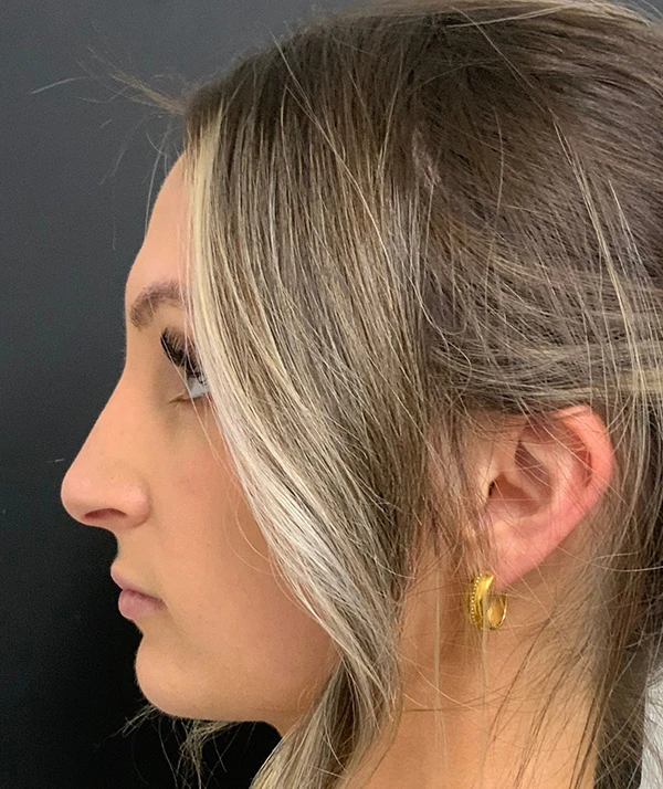 Rhinoplasty