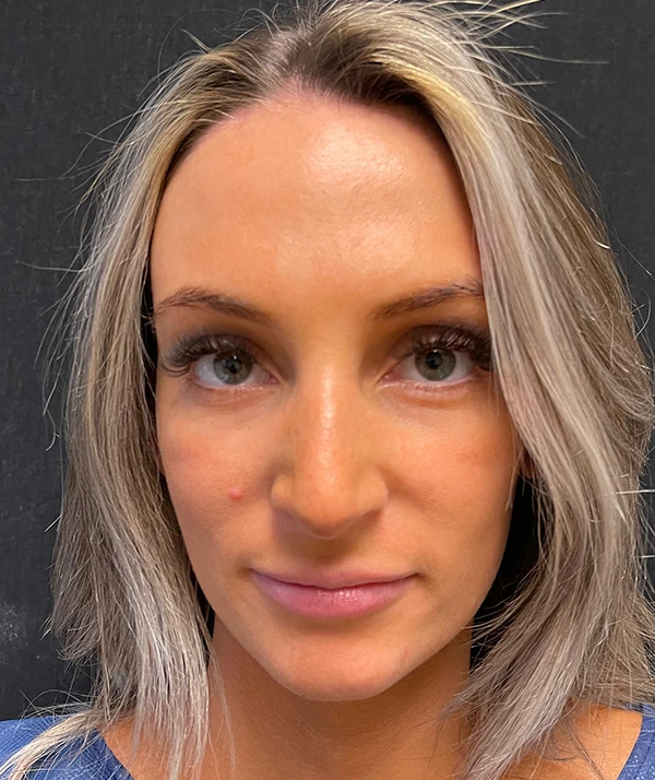 Rhinoplasty