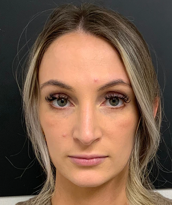 Rhinoplasty