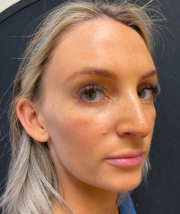 Rhinoplasty