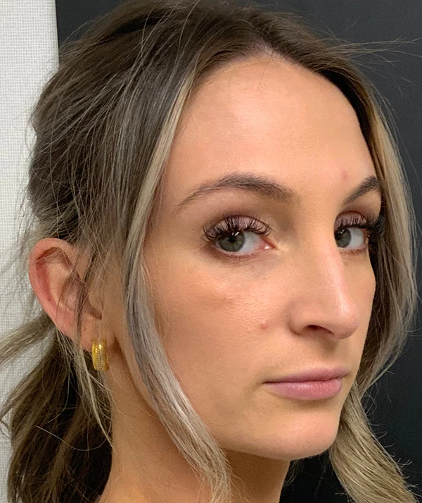 Rhinoplasty