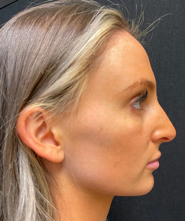 Rhinoplasty
