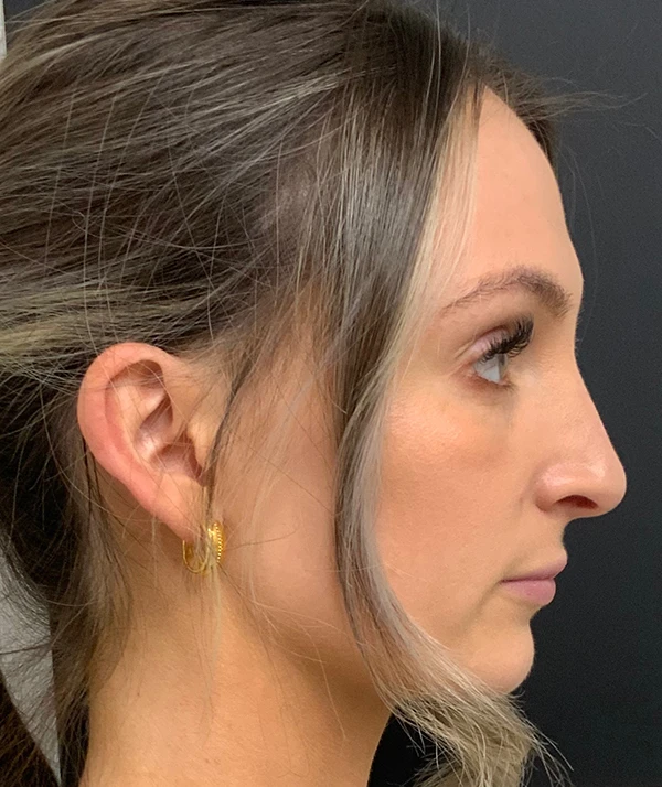 Rhinoplasty