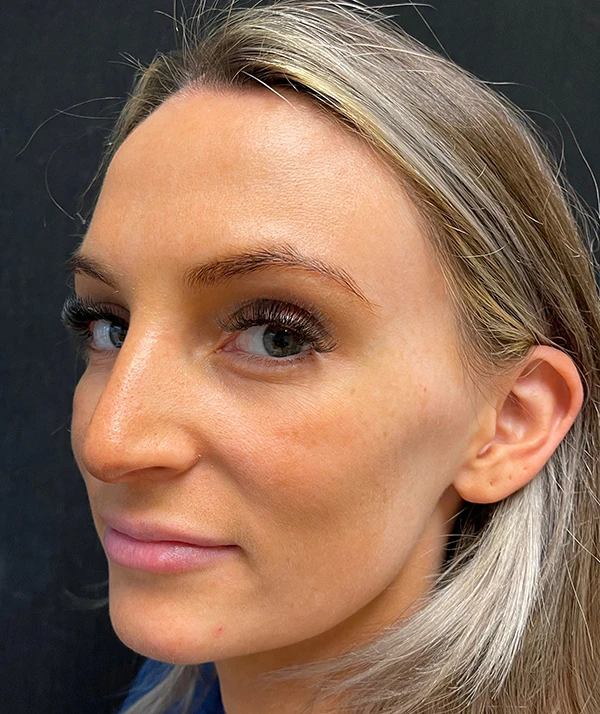 Rhinoplasty
