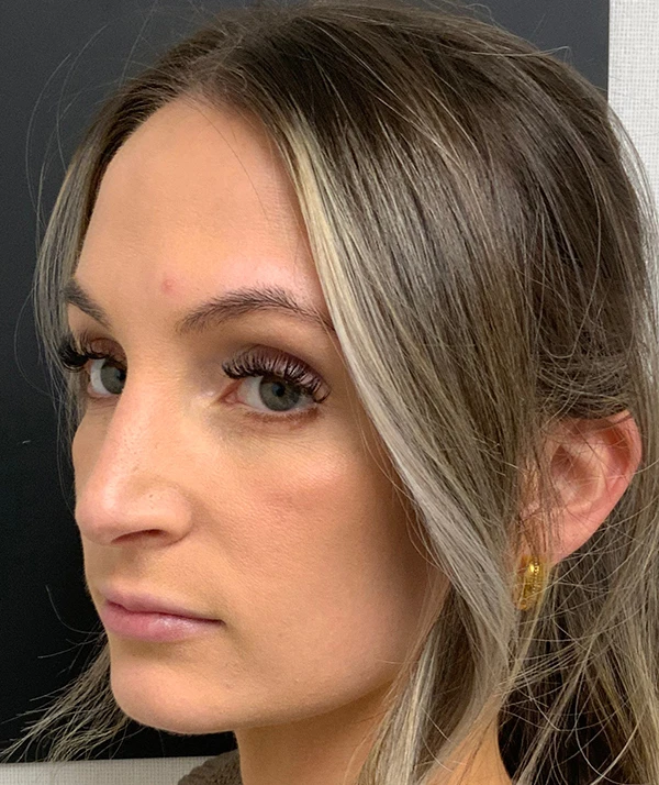 Rhinoplasty