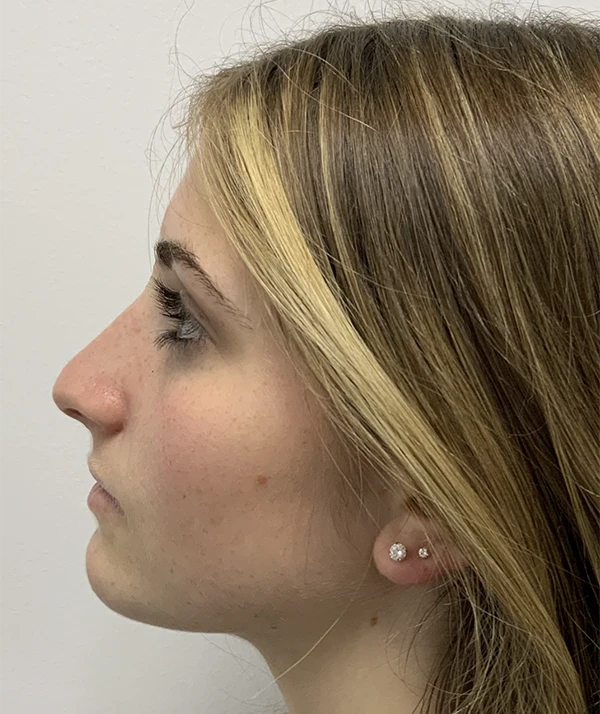 Rhinoplasty