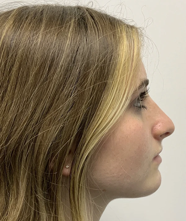 Rhinoplasty