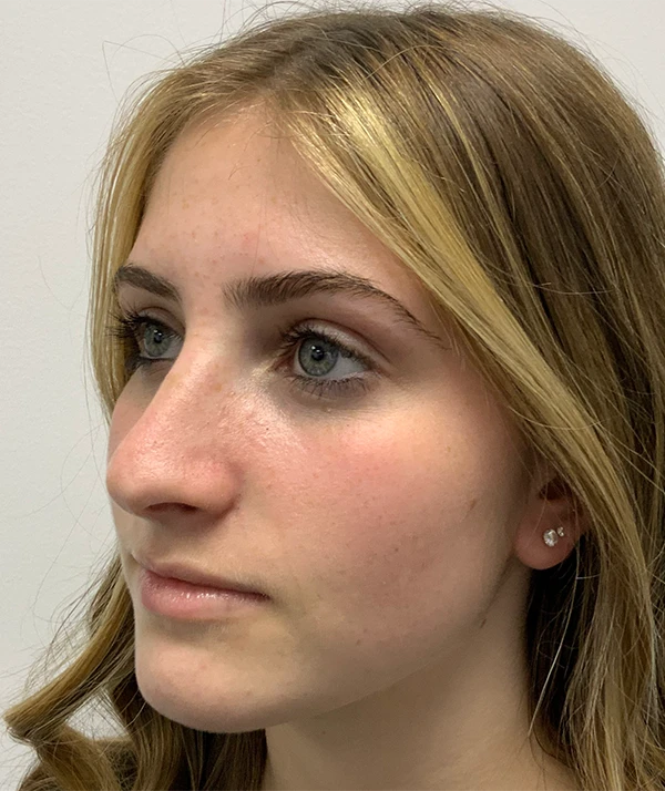 Rhinoplasty