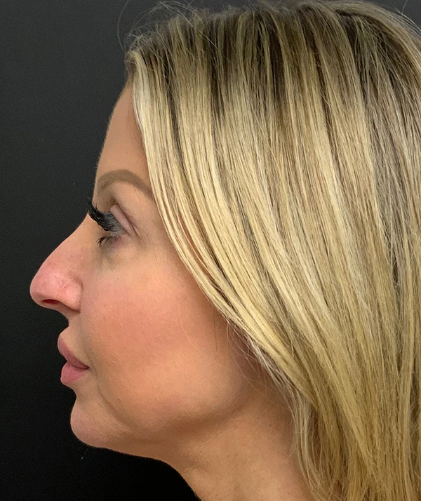 Rhinoplasty