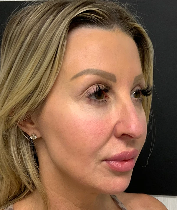 Rhinoplasty