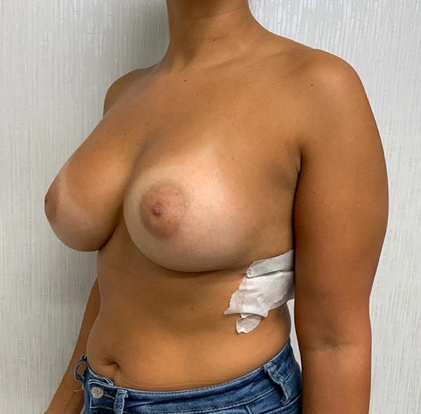 Breast Augmentation