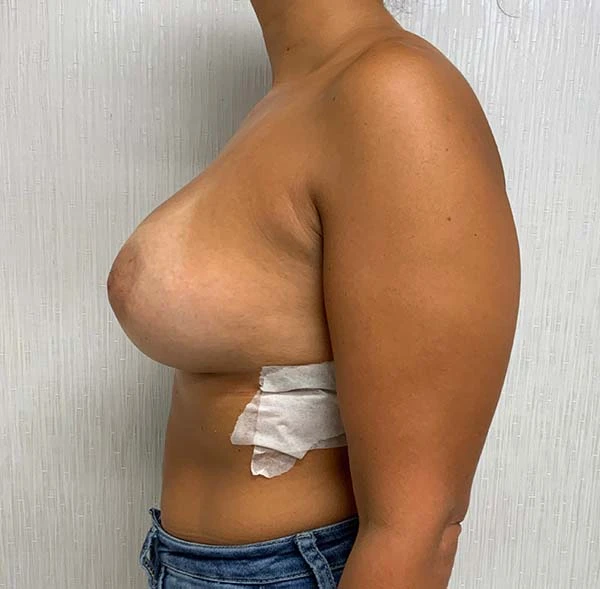 Breast Augmentation