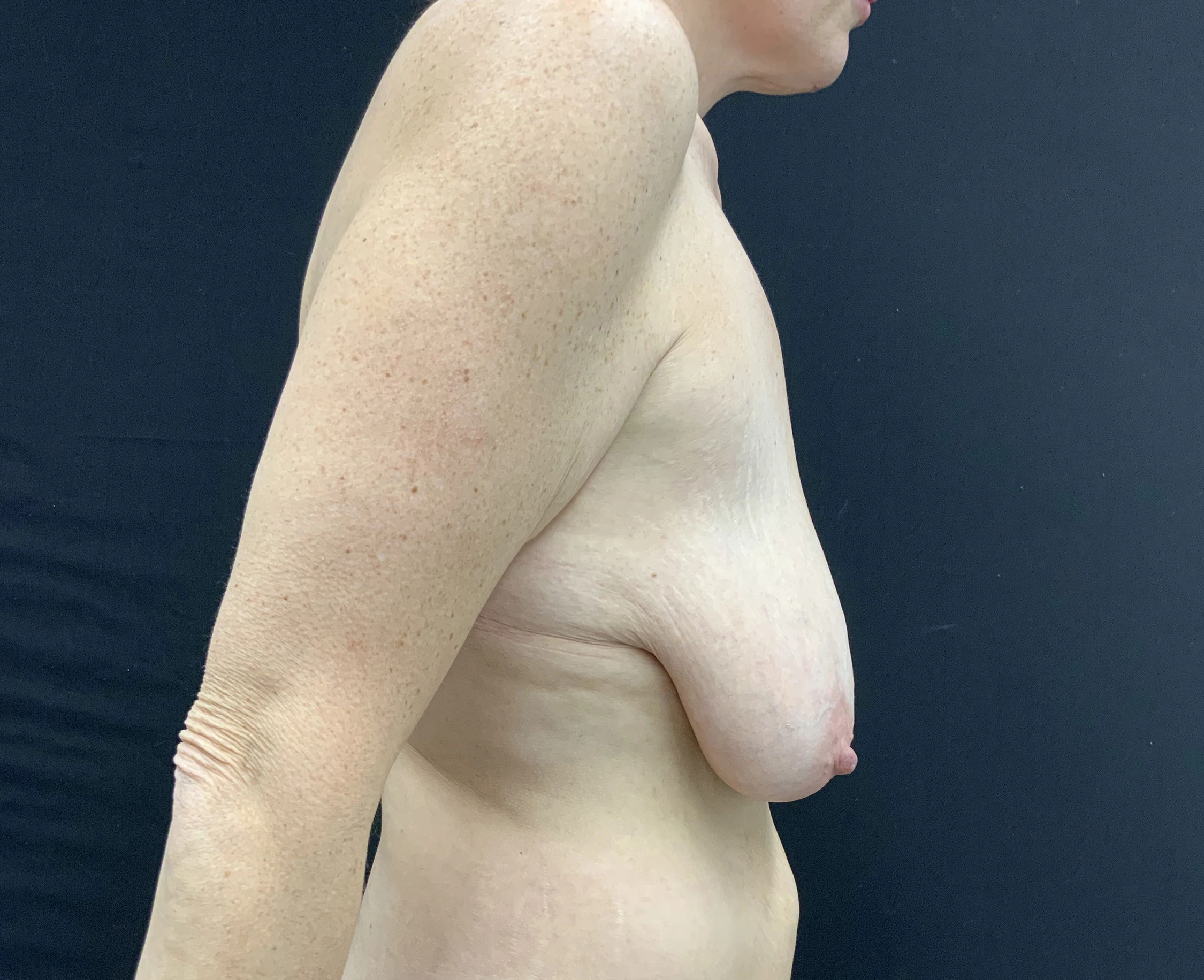 Breast Lift (No Implant)