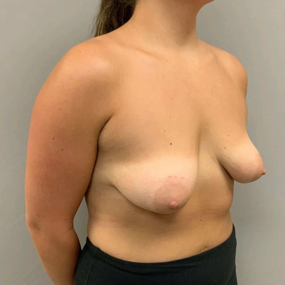 Breast Augmentation with Lift