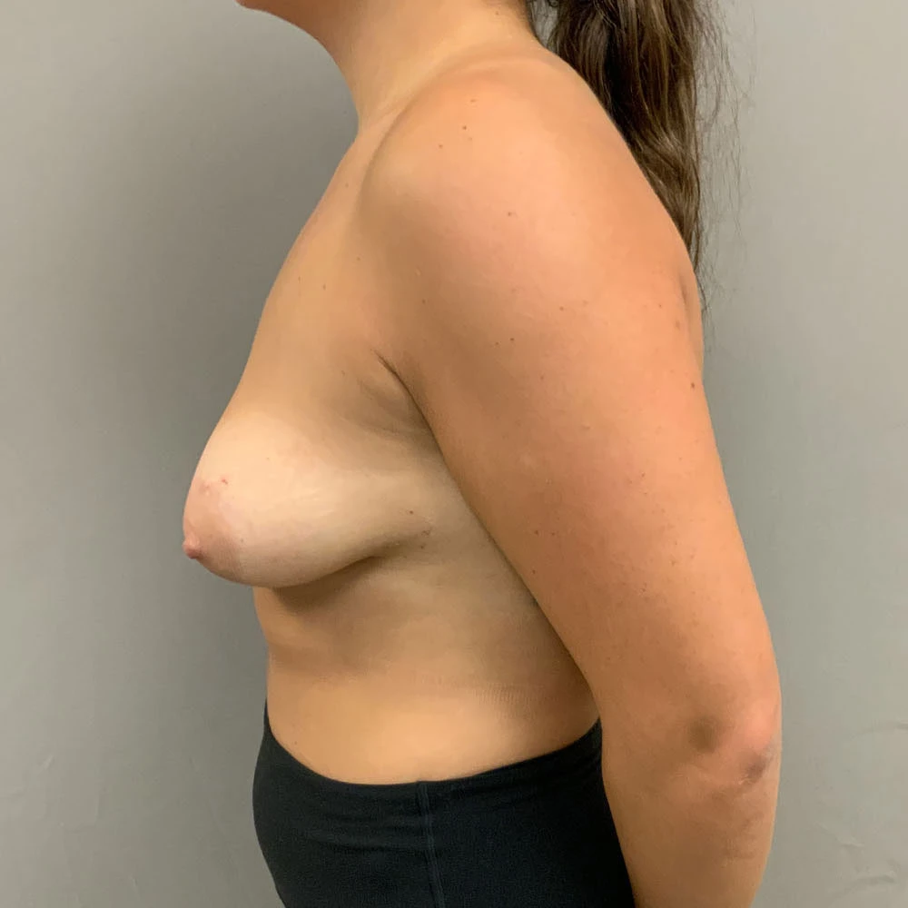 Breast Augmentation with Lift