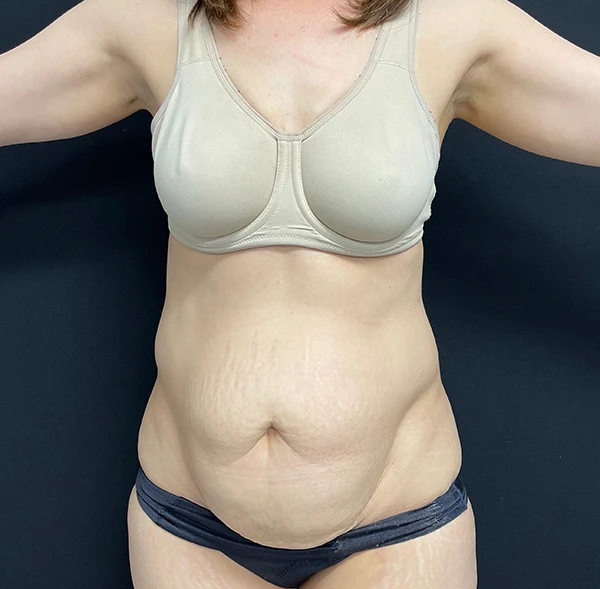 Tummy Tuck