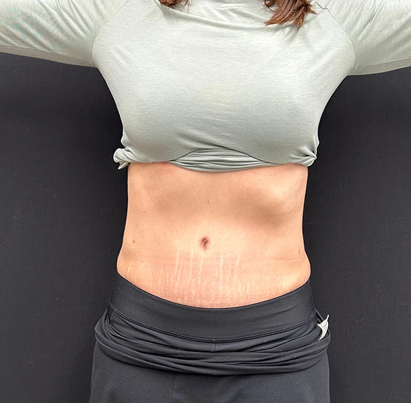 Tummy Tuck