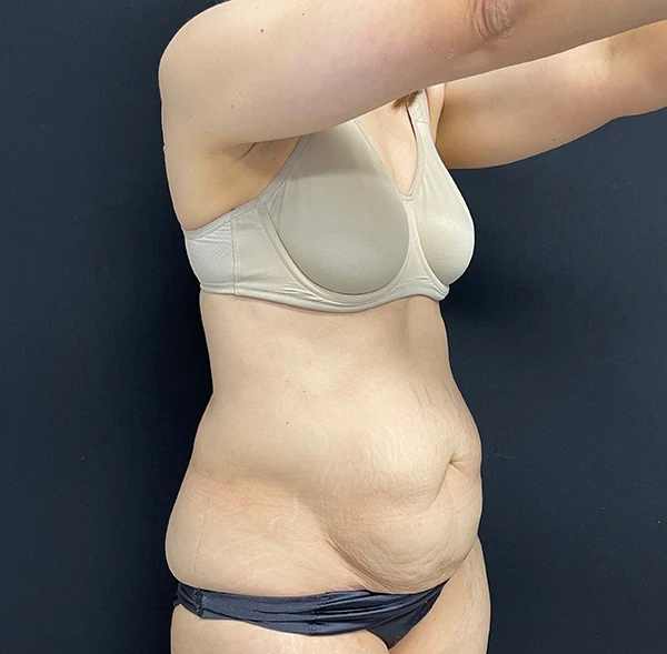 Tummy Tuck