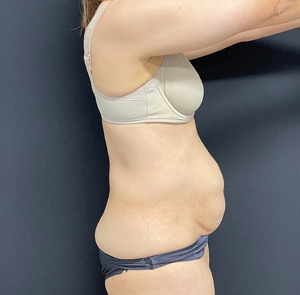 Tummy Tuck