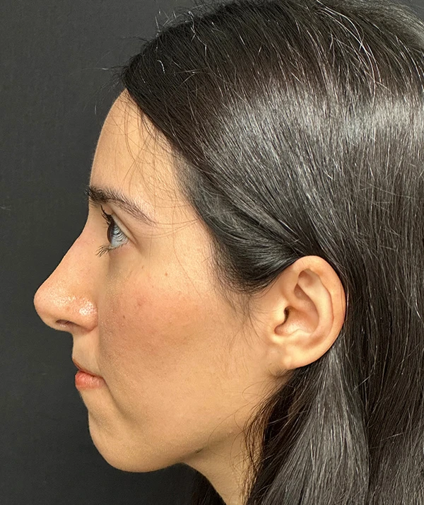 Rhinoplasty