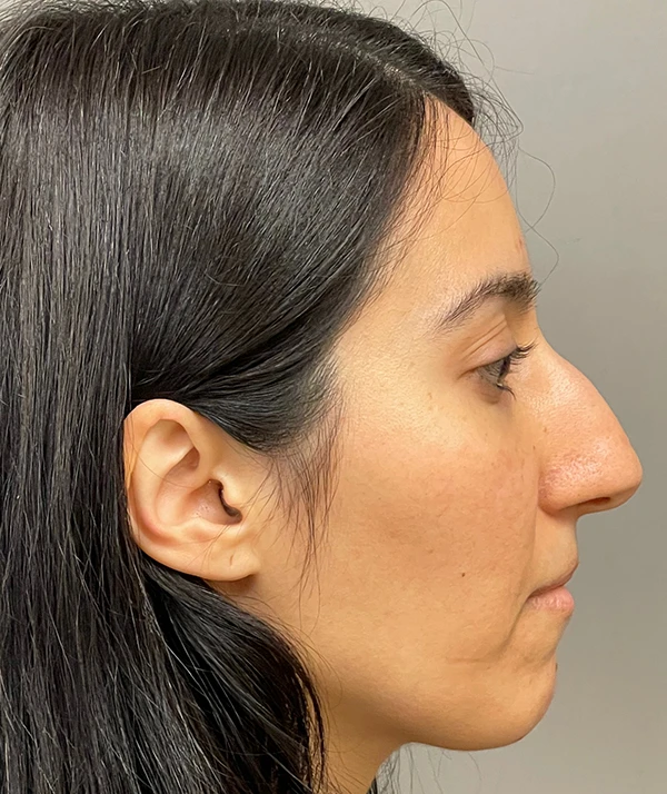 Rhinoplasty