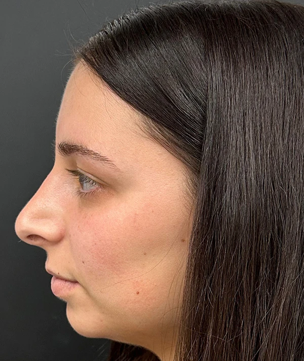 Rhinoplasty