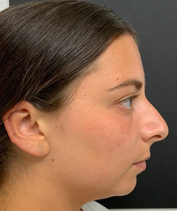 Rhinoplasty