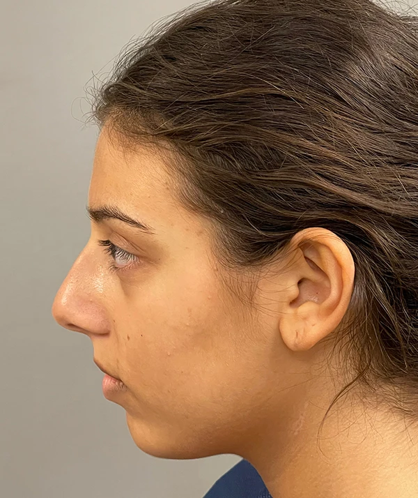 Rhinoplasty