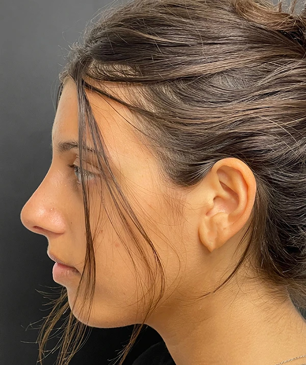 Rhinoplasty