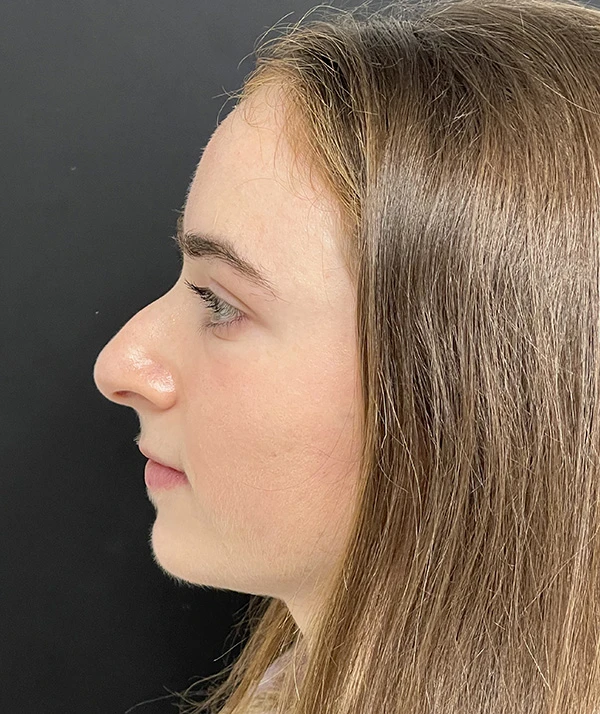 Rhinoplasty