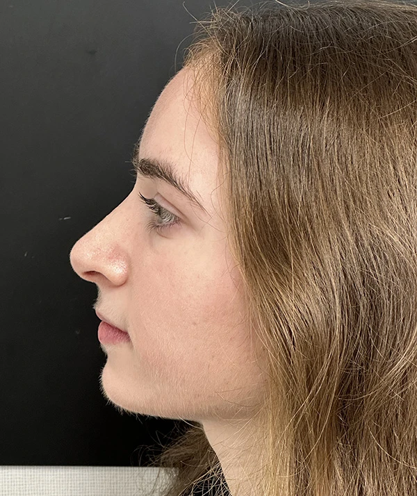 Rhinoplasty