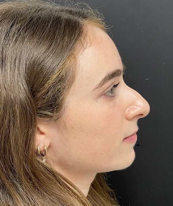 Rhinoplasty