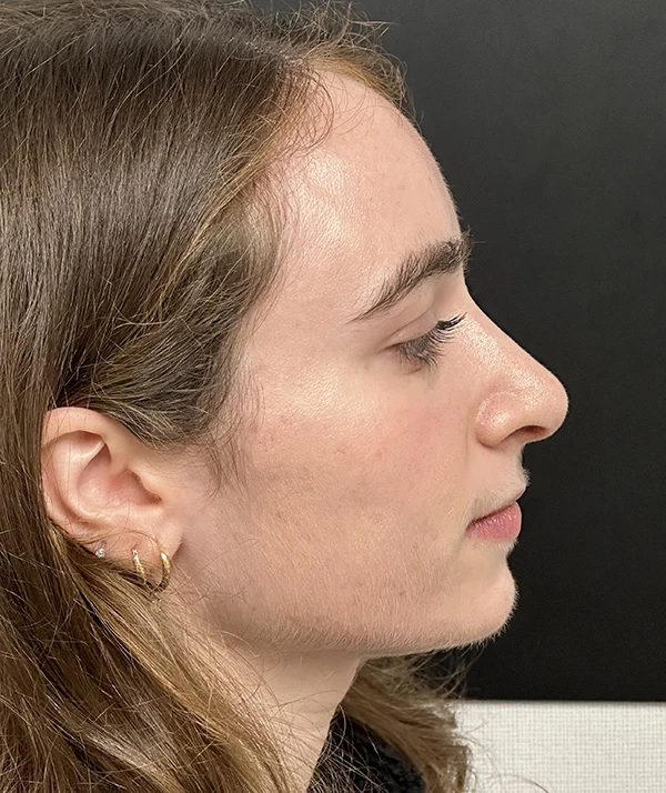 Rhinoplasty