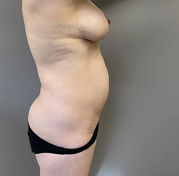 Tummy Tuck