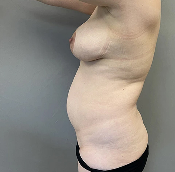 Tummy Tuck