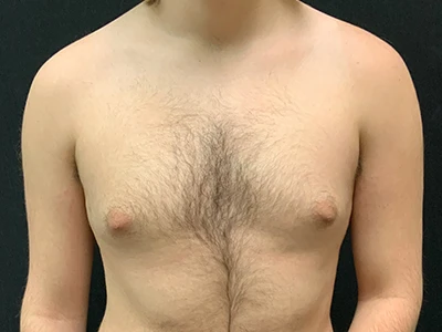 Gynecomastia