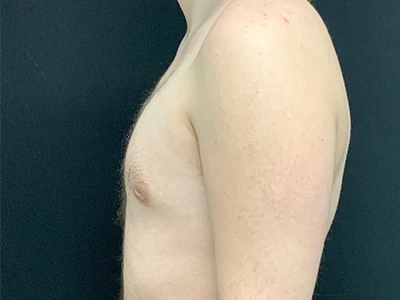 Gynecomastia