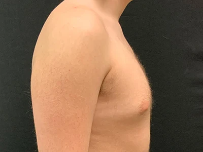 Gynecomastia