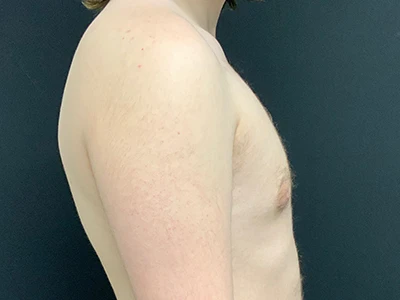 Gynecomastia