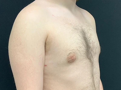 Gynecomastia